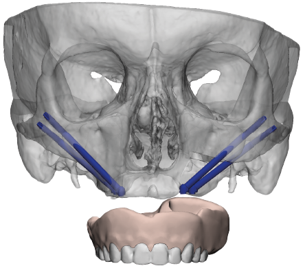 zygoma 3d planning