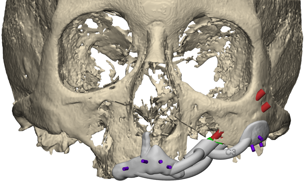 zygoma guide 1 transparent