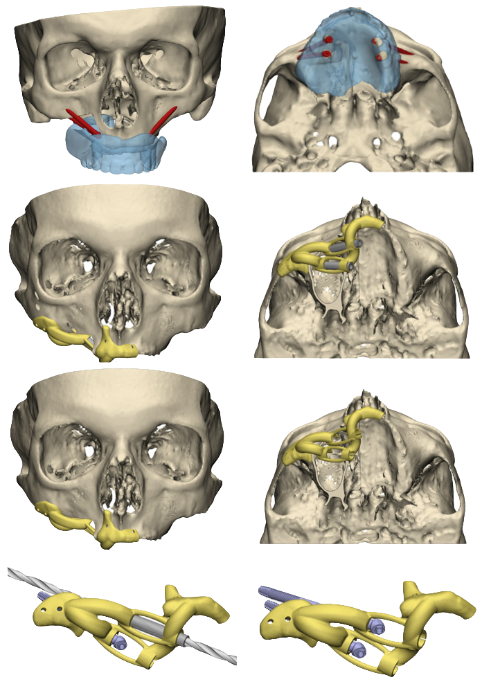 zygoma guide workflow transparent